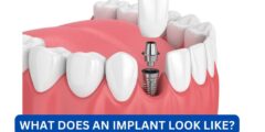 What does an implant look like